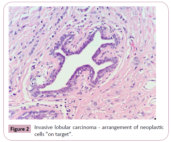annals-clinical-laboratory-lobular-carcinoma
