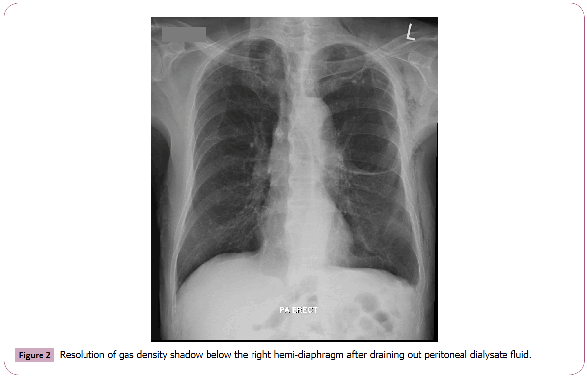 annals-clinical-laboratory-peritoneal-dialysate