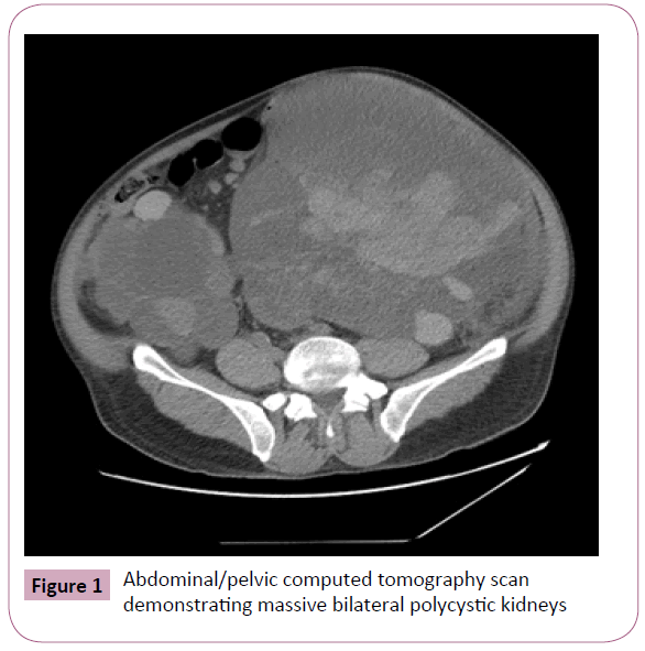 annals-clinical-laboratory-polycystic-kidneys