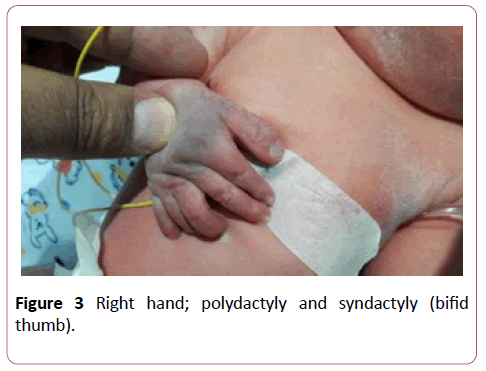 annals-clinical-laboratory-polydactyly