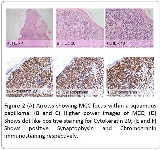 annals-clinical-laboratory-research-MCC-focus