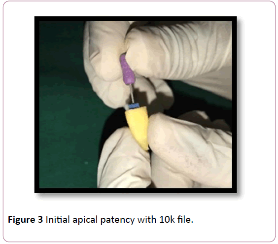 annals-clinical-laboratory-research-apical-patency