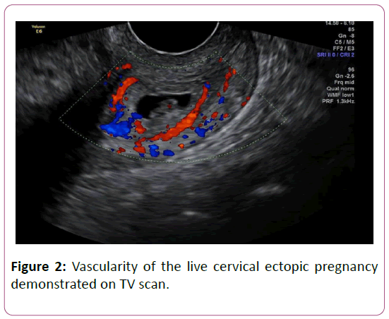 annals-clinical-laboratory-research-cervical-ectopic