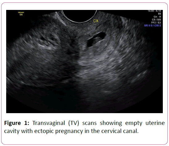 annals-clinical-laboratory-research-ectopic-pregnancy