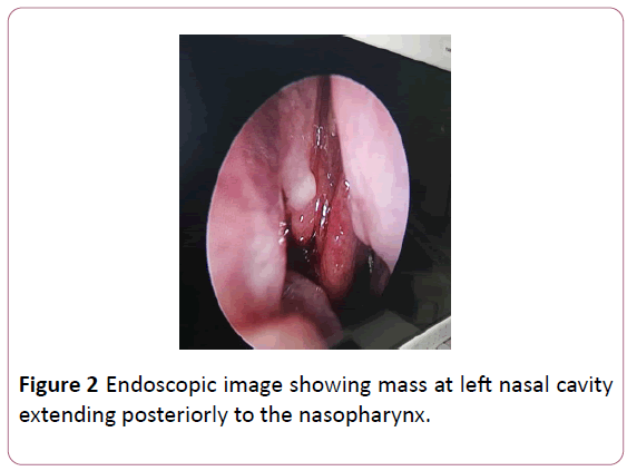 annals-clinical-laboratory-research-nasopharynx