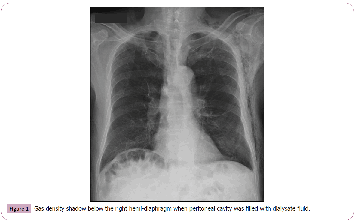 annals-clinical-laboratory-right-hemi-diaphragm