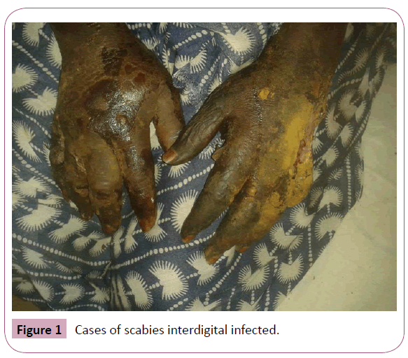 annals-clinical-scabies-interdigital