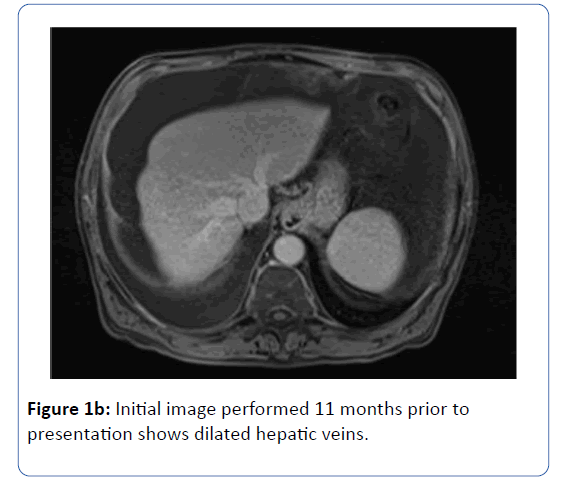 archives-medicine-dilated-hepatic-veins