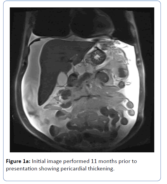 archives-medicine-pericardial-thickening