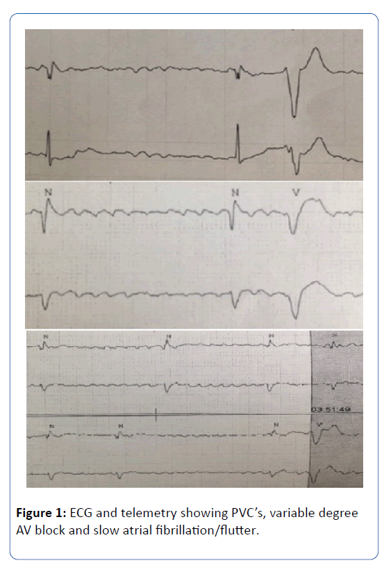 archives-medicine-slow-atrial-fibrillation