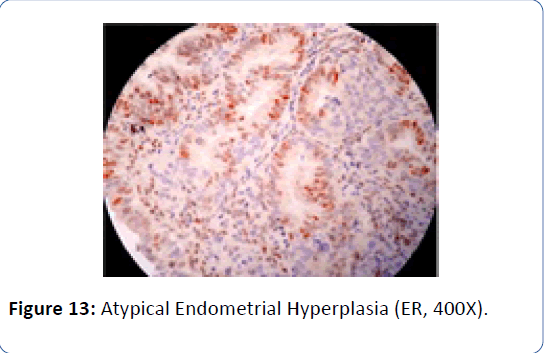 archivesofmedicine-Atypical-Endometrial