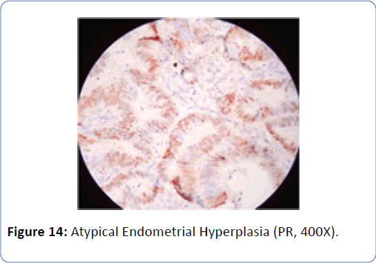 archivesofmedicine-Atypical-Endometrial