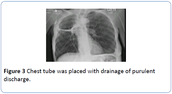 archivesofmedicine-Chest-tube-placed