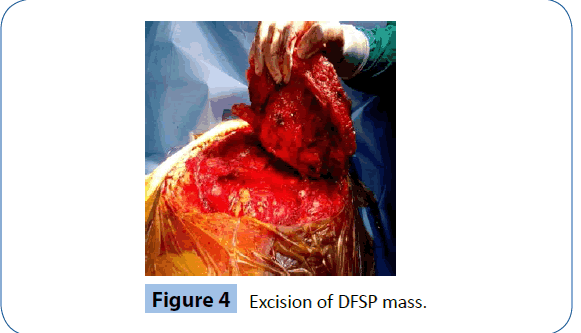 archivesofmedicine-DFSP-mass
