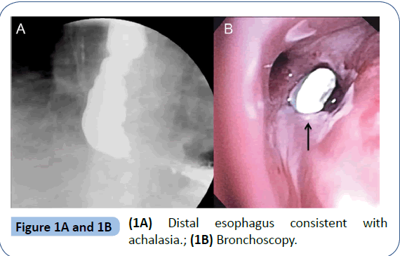 archivesofmedicine-Distal-esophagus