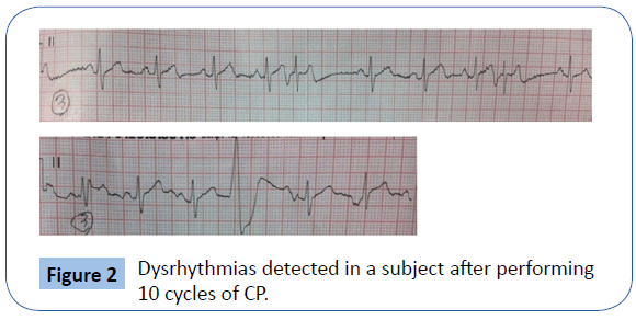 archivesofmedicine-Dysrhythmias-detected