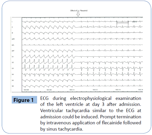 archivesofmedicine-ECG-during-electrophysiological