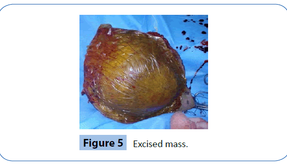 archivesofmedicine-Excised-mass