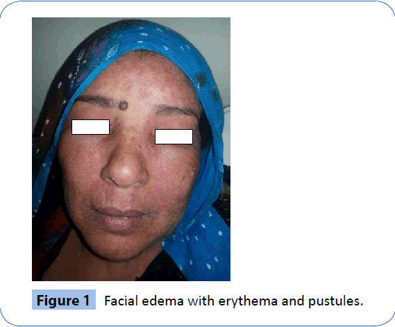 archivesofmedicine-Facial-edema