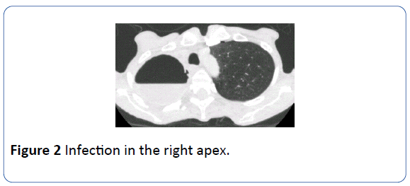 archivesofmedicine-Infection-right-apex