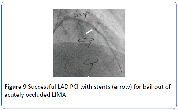 archivesofmedicine-LAD-PCI-stents