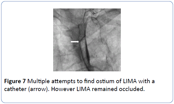 archivesofmedicine-LIMA-remained-occluded