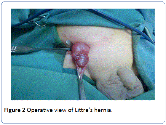 archivesofmedicine-Littre-hernia