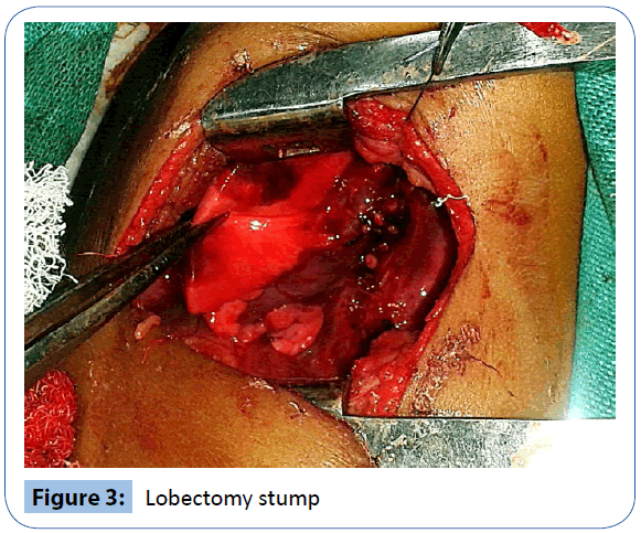 archivesofmedicine-Lobectomy-stump