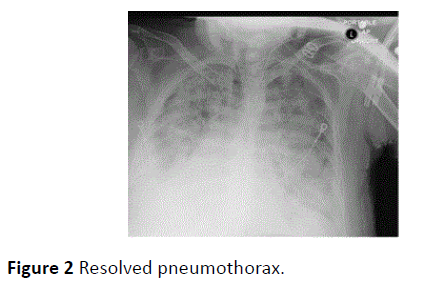 archivesofmedicine-Resolved-pneumothorax