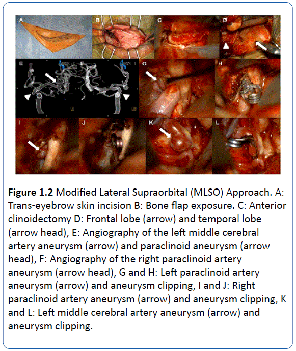 archivesofmedicine-Modified-Lateral-Supraorbital