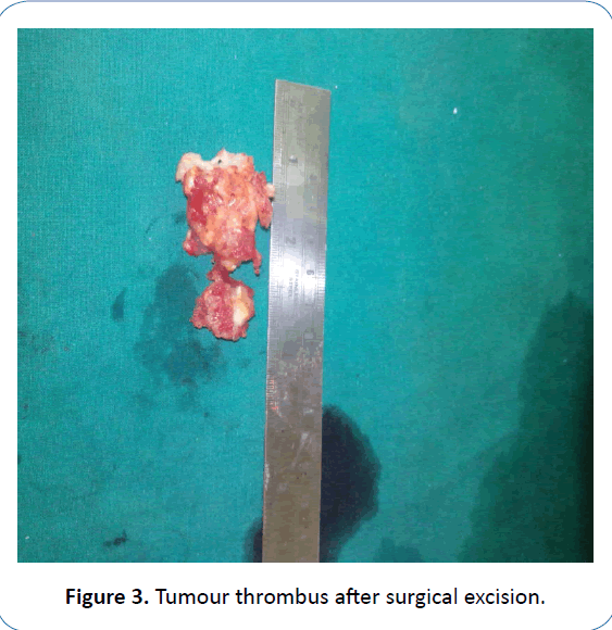 archivesofmedicine-Tumour-thrombus