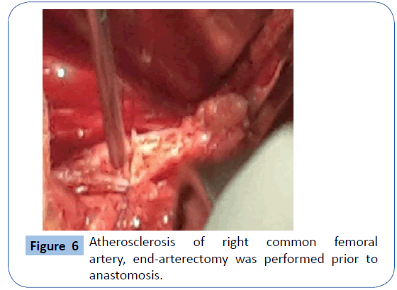 archivesofmedicine-artery-end-arterectomy