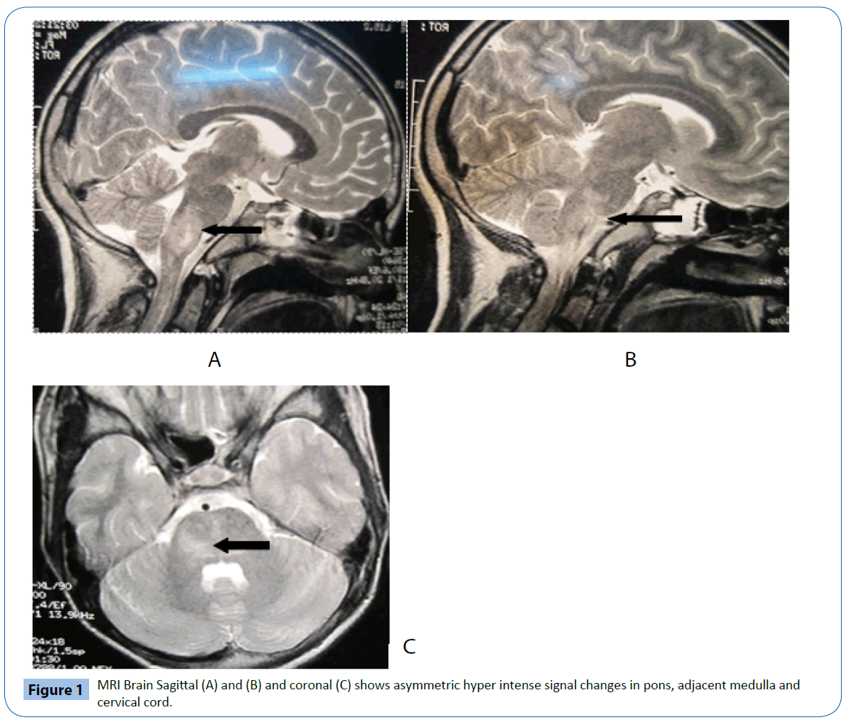 archivesofmedicine-asymmetric-hyper-intense