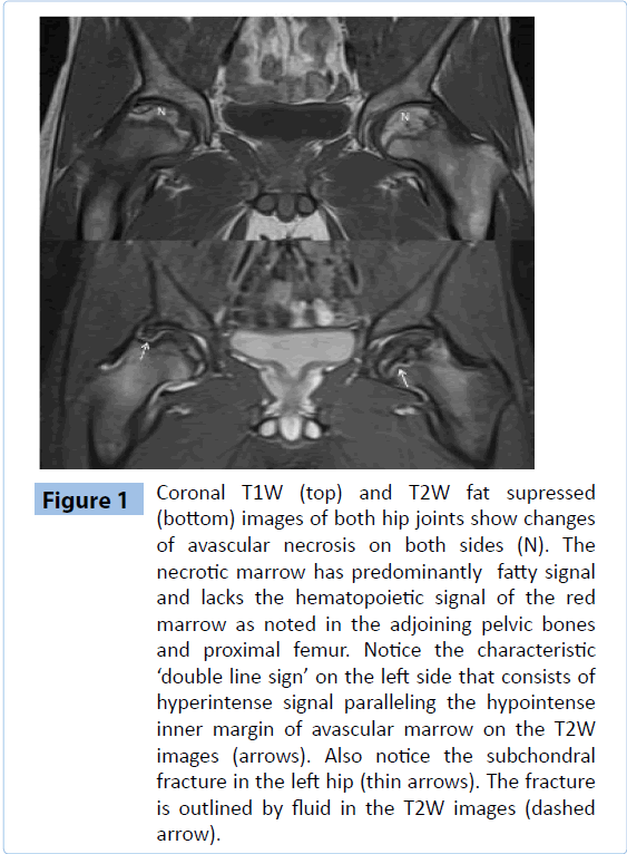 archivesofmedicine-avascular-necrosis