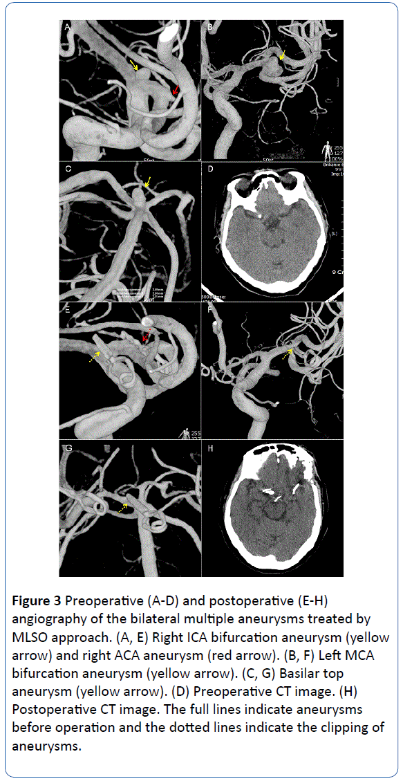 archivesofmedicine-bilateral-multiple-aneurysms