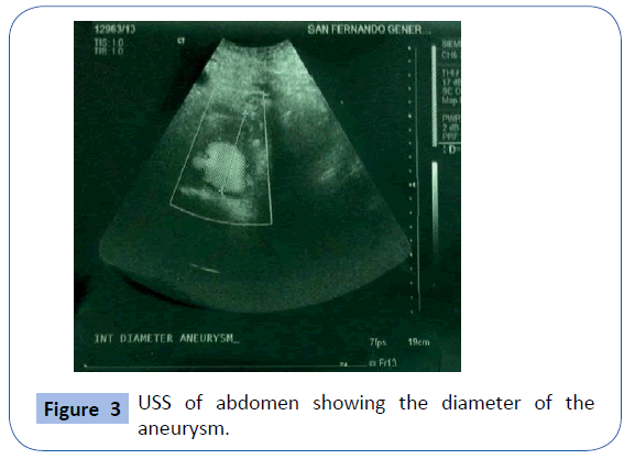 archivesofmedicine-diameter-aneurysm