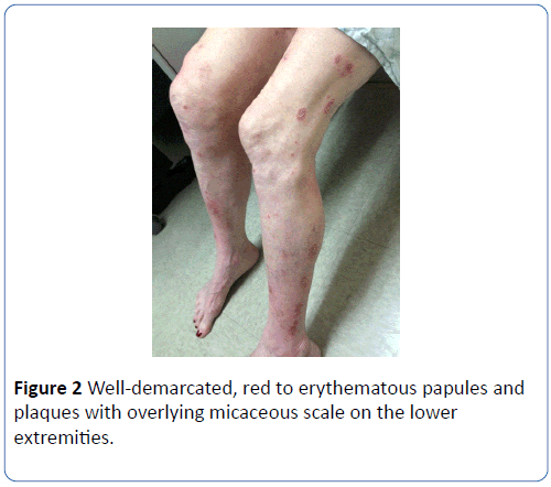 archivesofmedicine-erythematous-papules