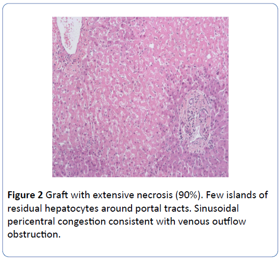 archivesofmedicine-extensive-necrosis