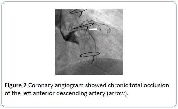 archivesofmedicine-left-anterior-descending-artery