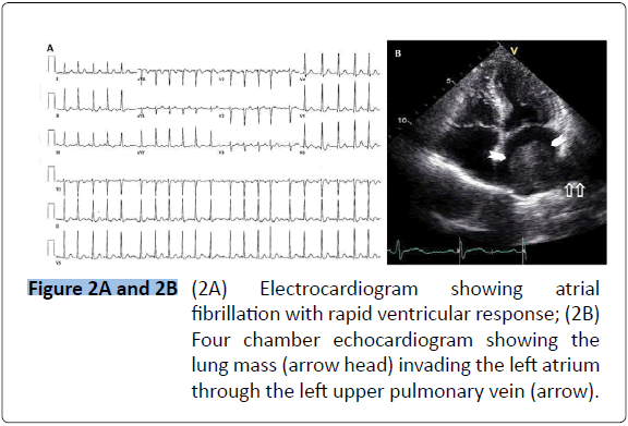 archivesofmedicine-left-atrium