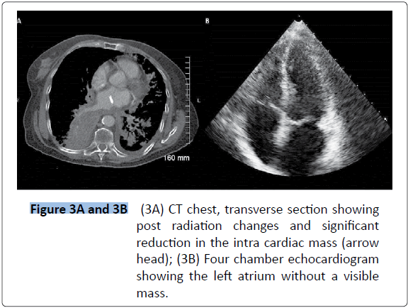 archivesofmedicine-left-atrium