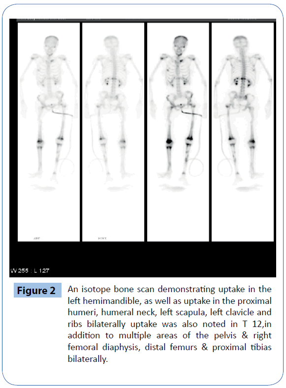 archivesofmedicine-left-hemimandible