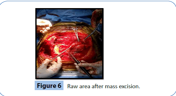 archivesofmedicine-mass-excision