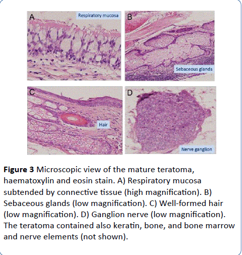 archivesofmedicine-mature-teratoma