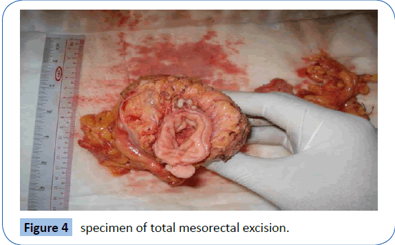 archivesofmedicine-mesorectal-excision