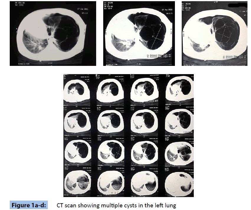 archivesofmedicine-multiple-cysts-left-lung