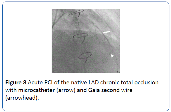 archivesofmedicine-native-LAD-chronic