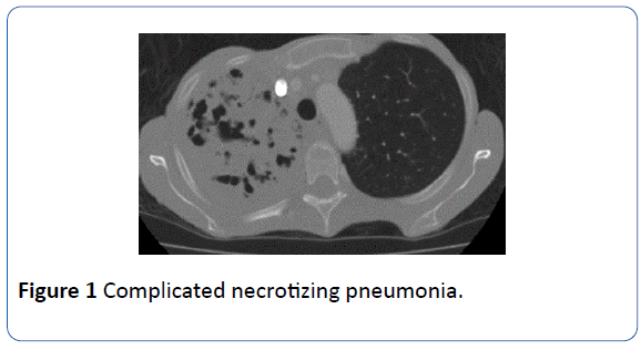 archivesofmedicine-necrotizing-pneumonia