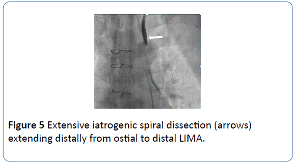 archivesofmedicine-ostial-distal-LIMA