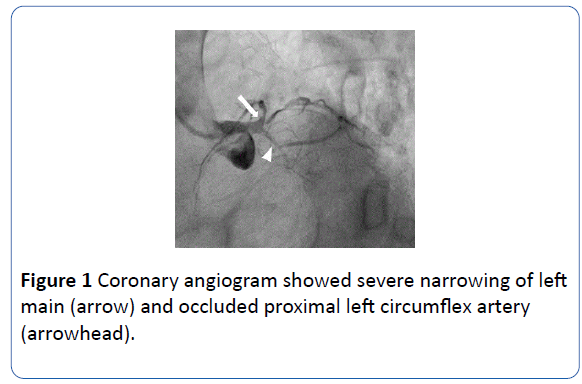 archivesofmedicine-proximal-left-circumflex